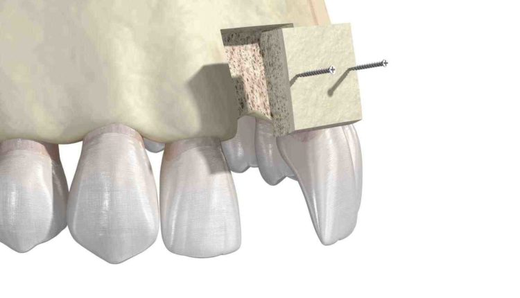 How long after teeth extraction to allow dental implant with bone graft