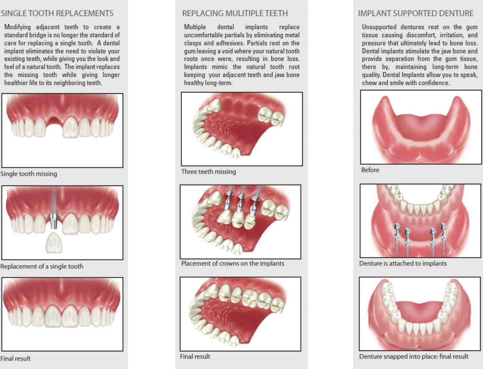 How long do cosmetic fillings last?