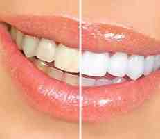 How long do full arch dental implants last?