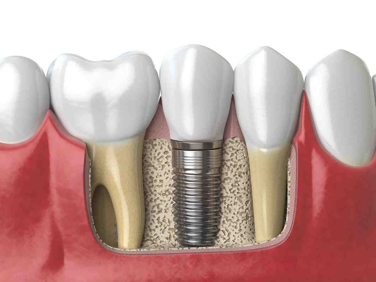 How long do full mouth implants last?