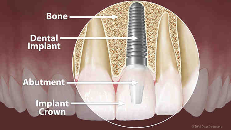How long does it take for dental implants to fall out?