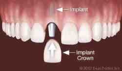How long does it take to attach a crown to an implant?