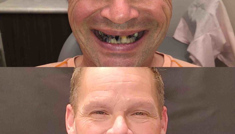 How long does it take to do dental implants