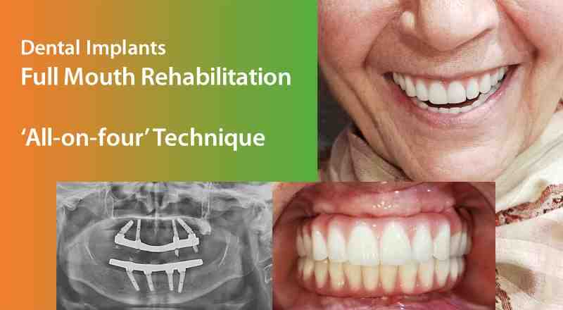 How long does it take to get dental implants from start to finish?