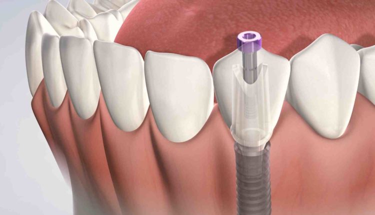 How long does it take to put in a dental implant