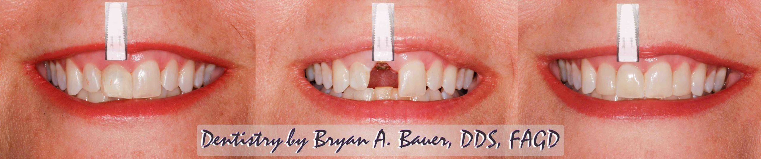 How long does the pain last after a dental implant?