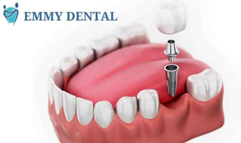 How long does the pain last after a dental implant?