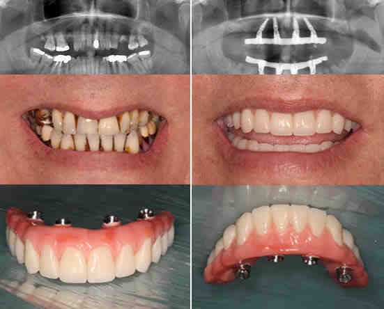 How many implants does it take to replace all your teeth?