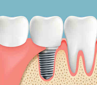 How many years do dental implants last?