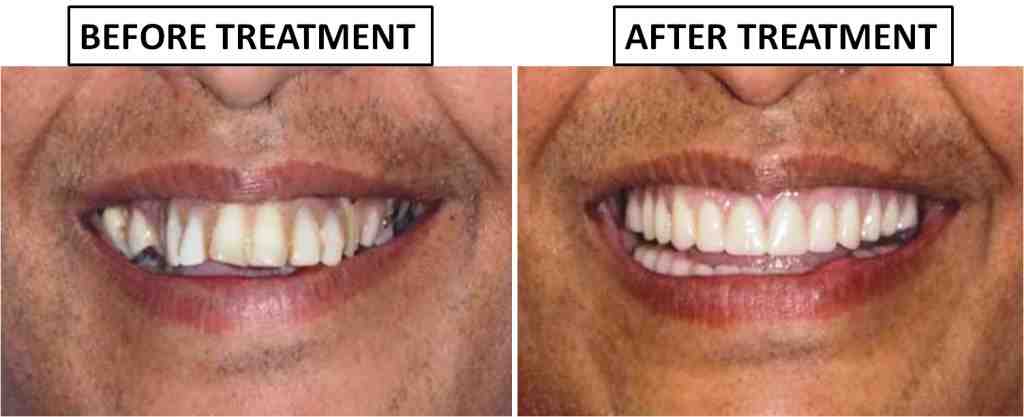How much are full mouth implants in India?
