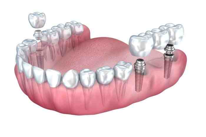 How much are teeth implants in Mexico?