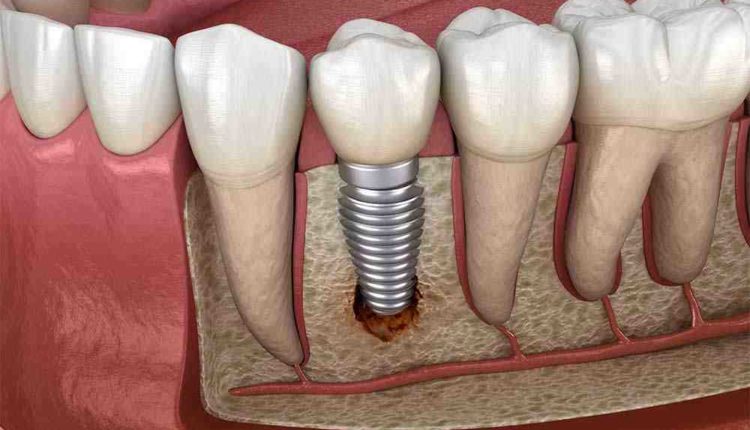 How much delta dental pay dentist for implants