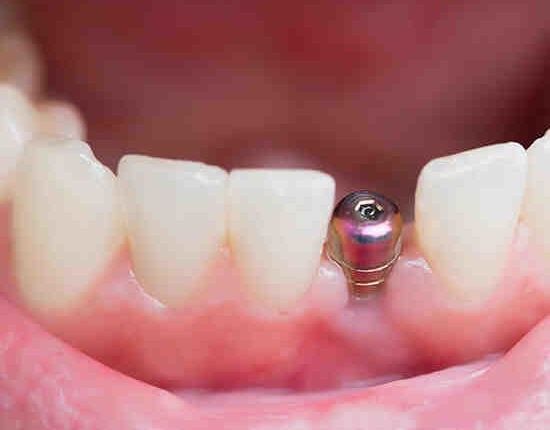 How much do dental implants cost ?