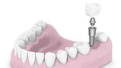 How much do dental implants cost in France?