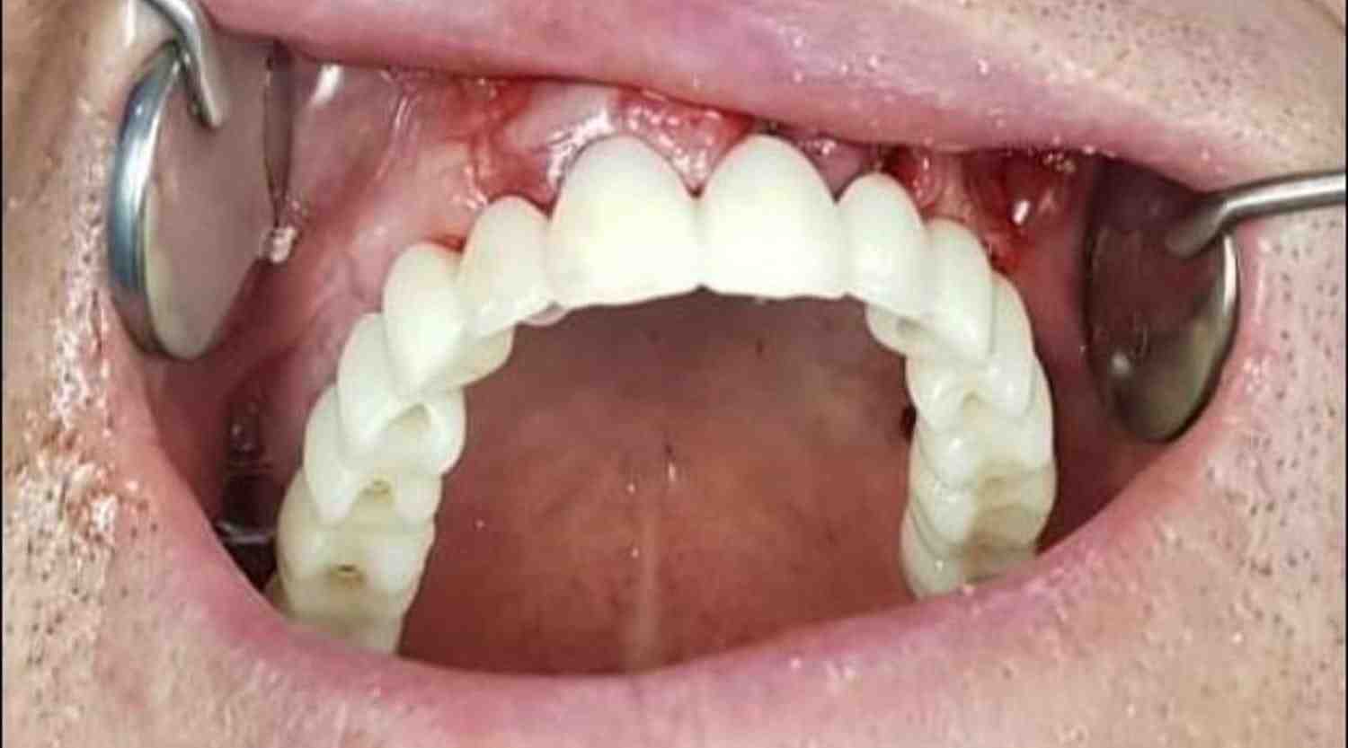 How much does a bone graft and gum cost?