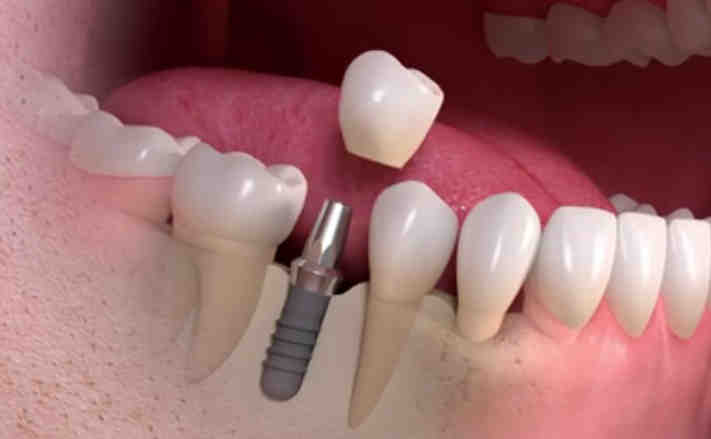 How much does a full set of teeth implants cost Turkey?
