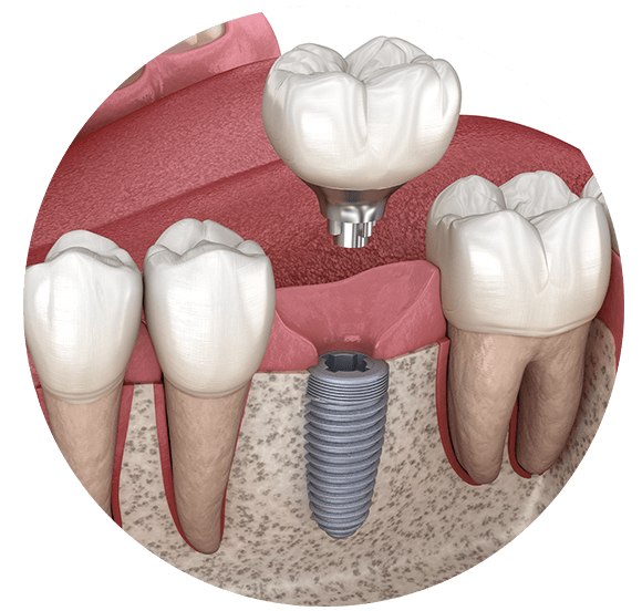 Where to go for dental implant in mexico Dental News Network