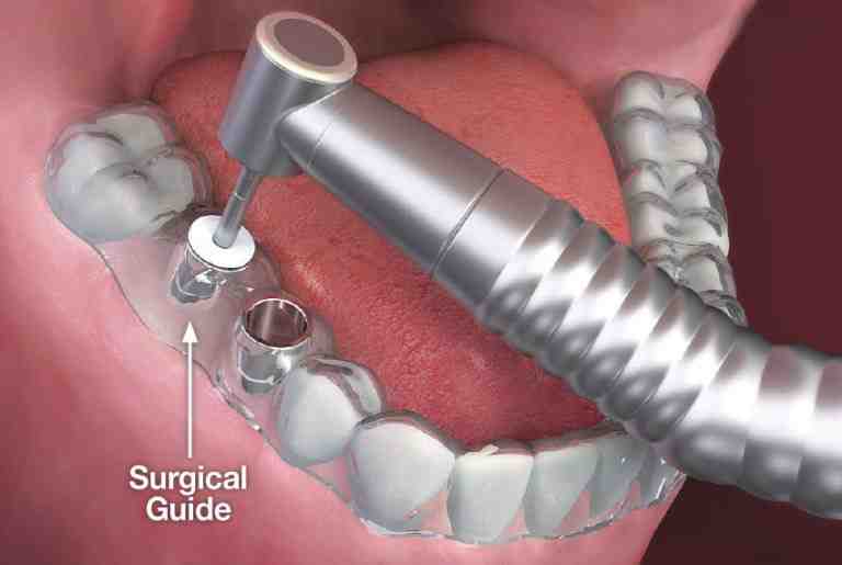 How much does it cost to get a new mouth full of teeth?