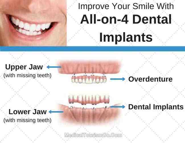 How much is a flipper tooth?