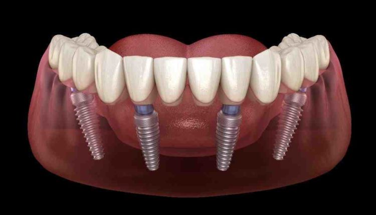 How much is a single dental implant cost?