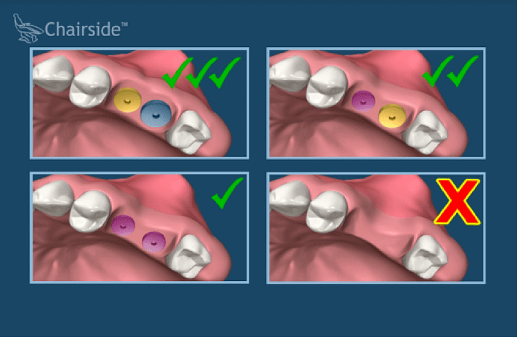 How serious is a bone graft?