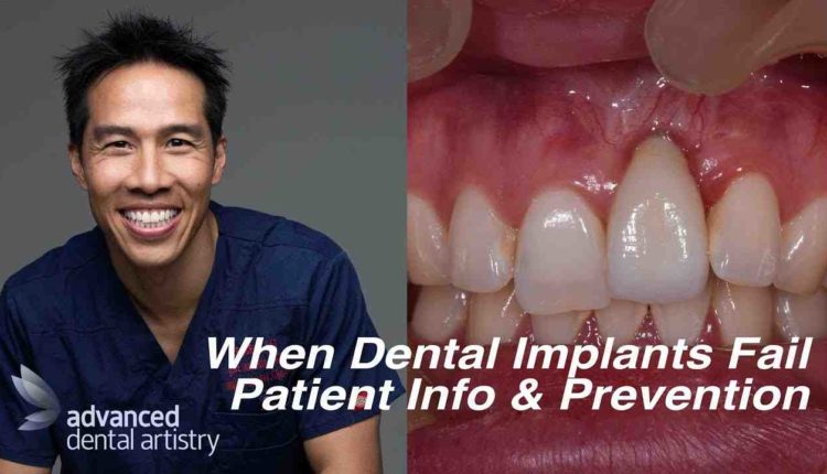 How soon after surgery will you know if dental implant failing