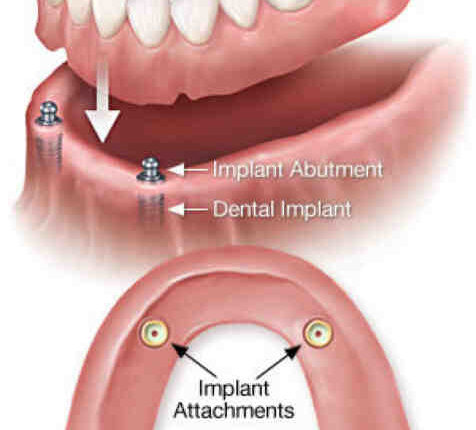 How t decide whether to get a dental implant