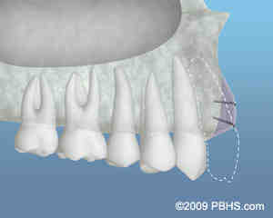 Is a bone graft painful?