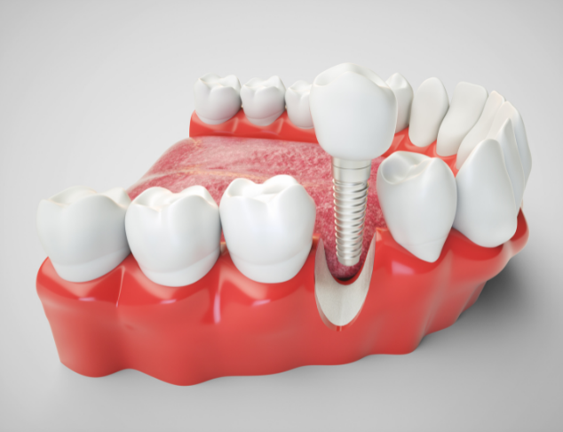 Is dental bone graft major surgery?