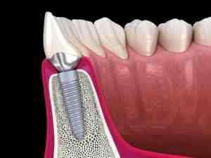 Is dental implant failure common?