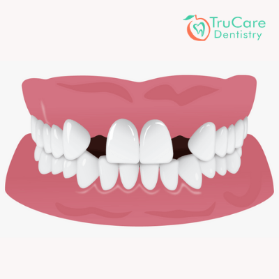 Is gap between front teeth attractive?