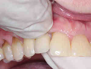 Is it normal for a dental implant to wiggle?