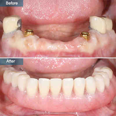 Is it normal for a tooth implant to move?