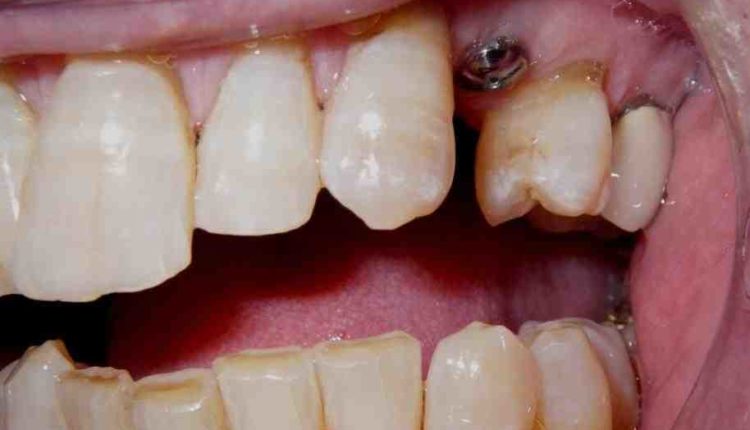 Is it painful to get a dental implant?
