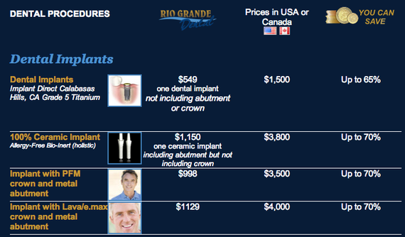 Is it worth it to get dental implants in Mexico?