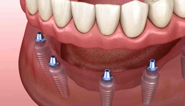 Should i get all on 4 dental implants