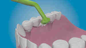 Should my implant feel loose?