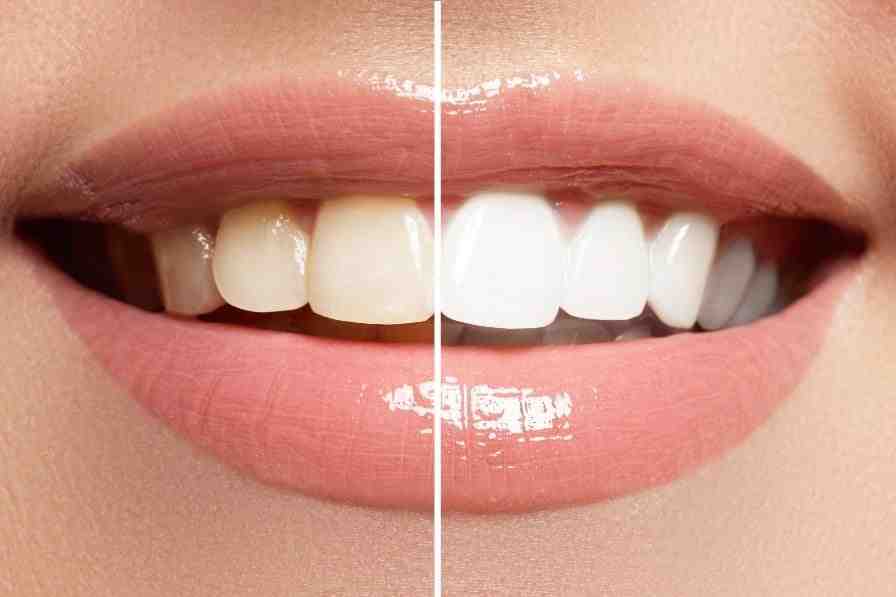 What are Turkey teeth?