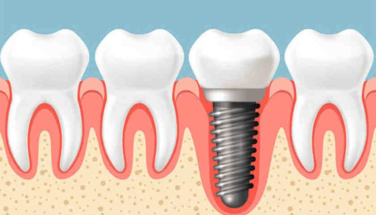 What are my options when dental implants fail because of severe bone loss