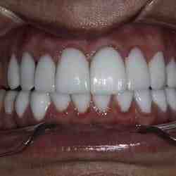 What are standard dental implants?