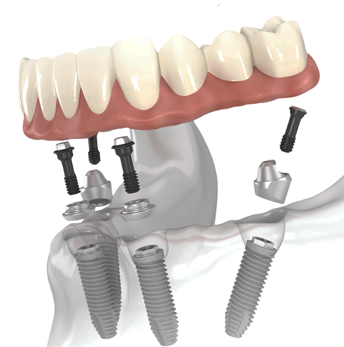 What are the problems with dental implants?
