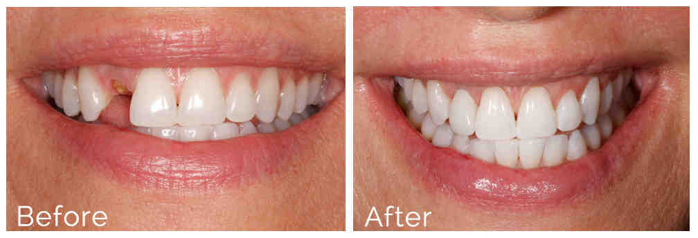 What are the pros and cons of denture implants?