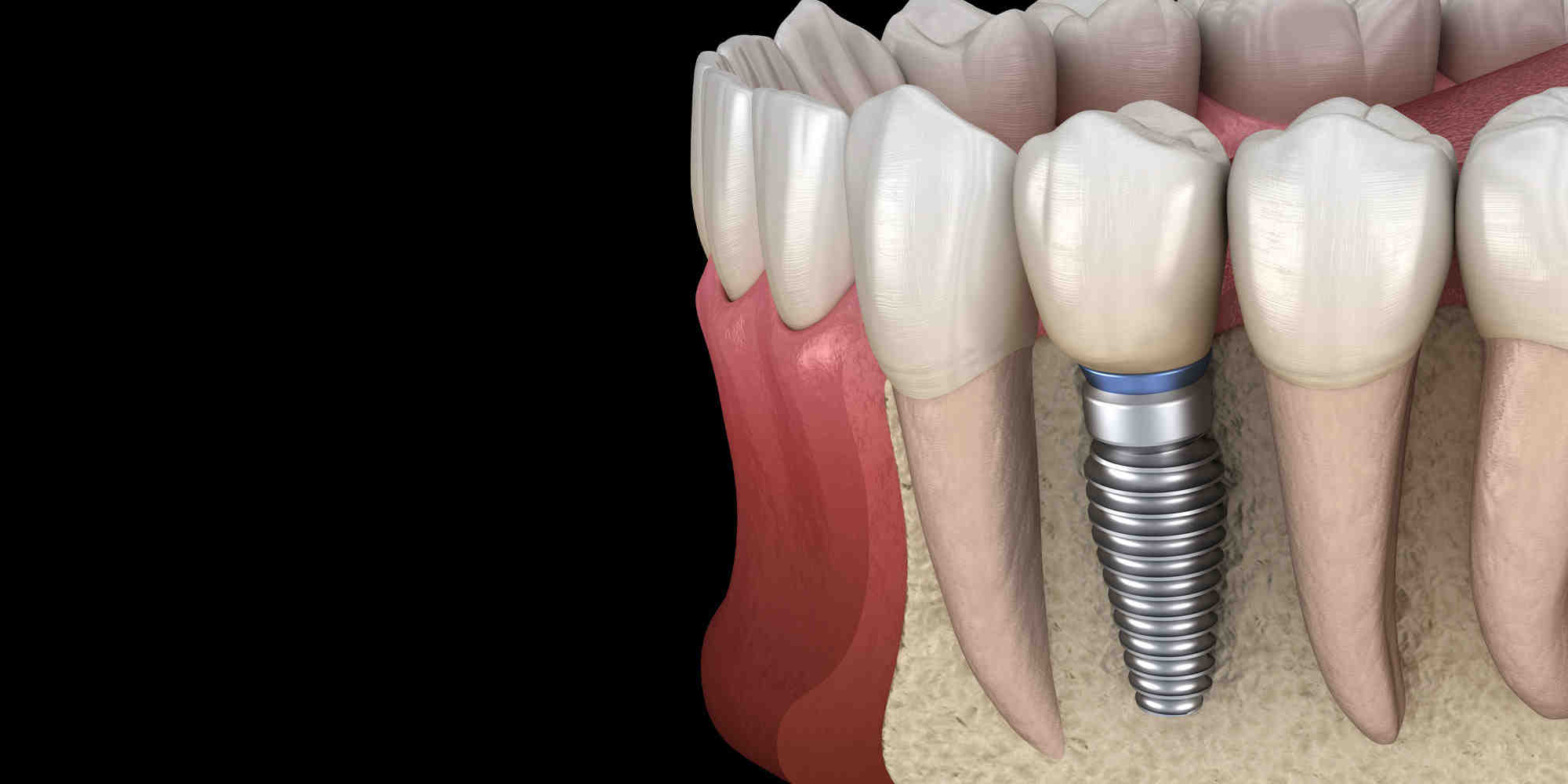 What are the signs of a failed dental bone graft?