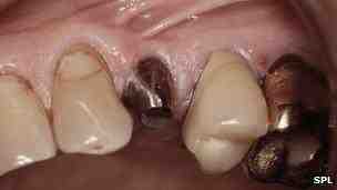 What are the symptoms of a dental implant rejection?