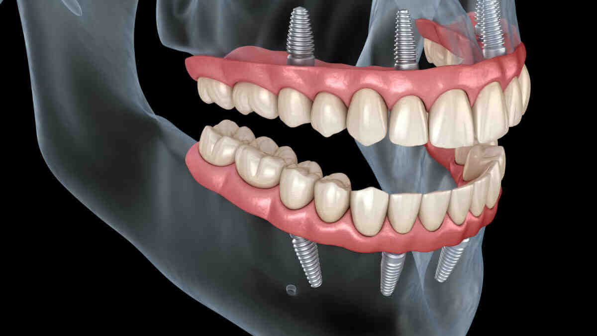 What can you eat and drink after implant surgery?