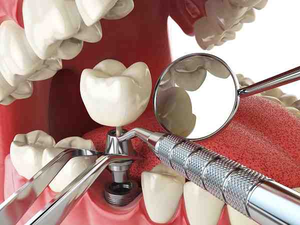 What do I do if my implant screw is loose?