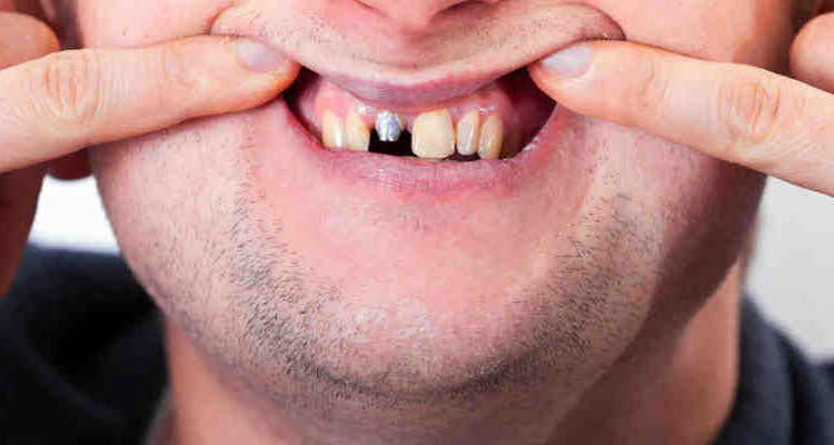 What do if dental implant infected