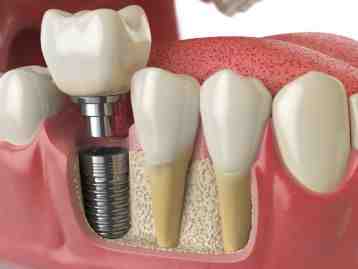 What do you do if a dental implant screw falls out?
