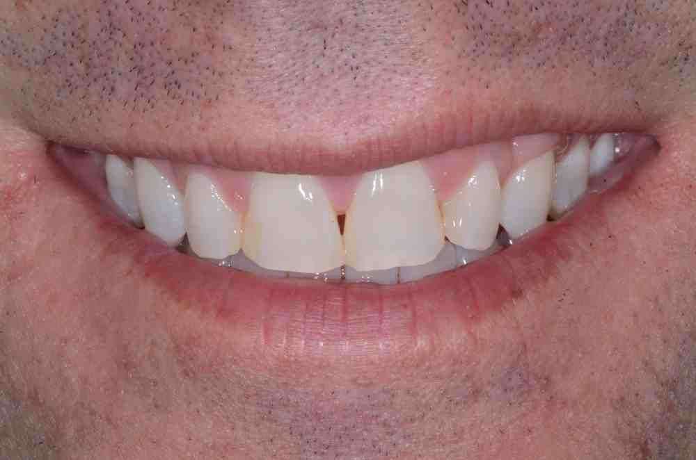 What happens if an abscess bursts in your mouth and you swallow it?
