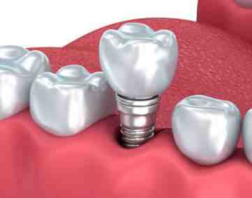 What happens if an implant comes loose?